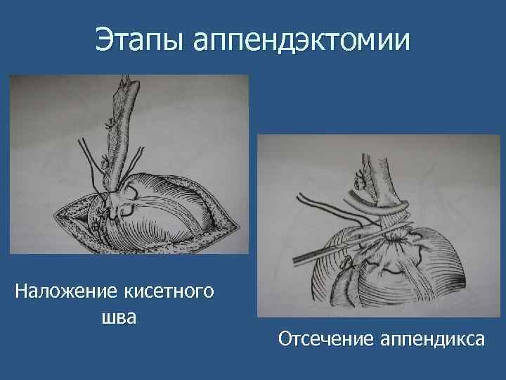 План обследования пациента с острым аппендицитом