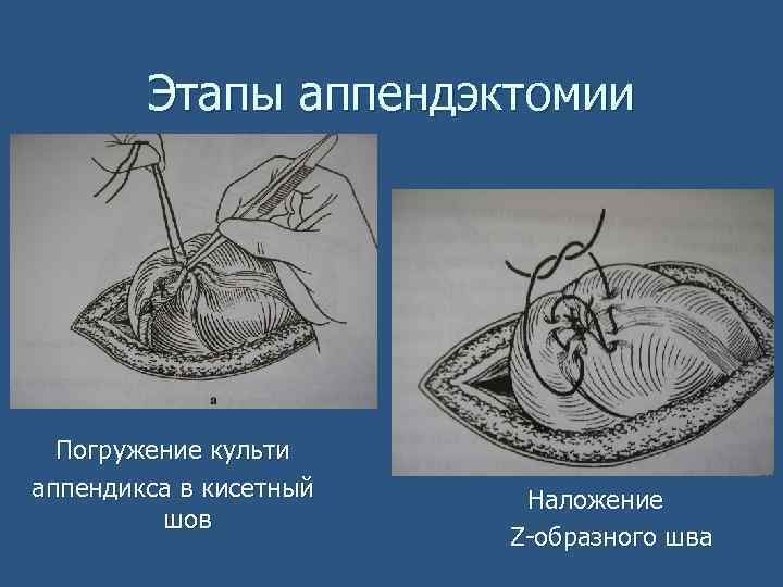 Этапы аппендэктомии Погружение культи аппендикса в кисетный шов Наложение Z-образного шва 