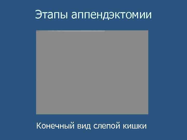 Этапы аппендэктомии Конечный вид слепой кишки 