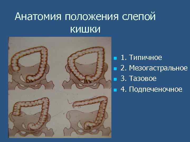 Анатомия положения слепой кишки n n 1. Типичное 2. Мезогастральное 3. Тазовое 4. Подпеченочное