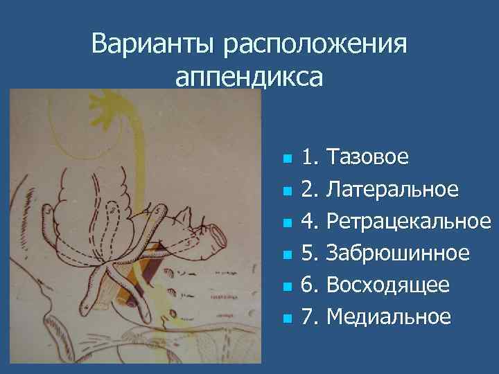 Варианты расположения аппендикса n n n 1. Тазовое 2. Латеральное 4. Ретрацекальное 5. Забрюшинное