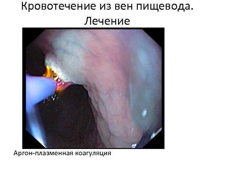 Кровотечение из вен пищевода. Лечение Аргон-плазменная коагуляция 