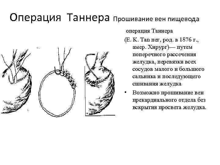 Операция Таннера Прошивание вен пищевода операция Таннера (Е. К. Tan пег, род. в 1876