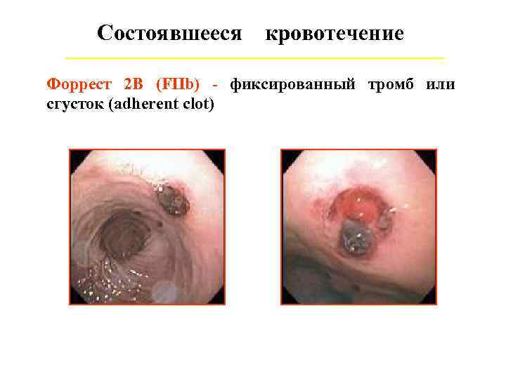 Состоявшееся кровотечение Форрест 2 В (FIIb) - фиксированный тромб или сгусток (adherent clot) 