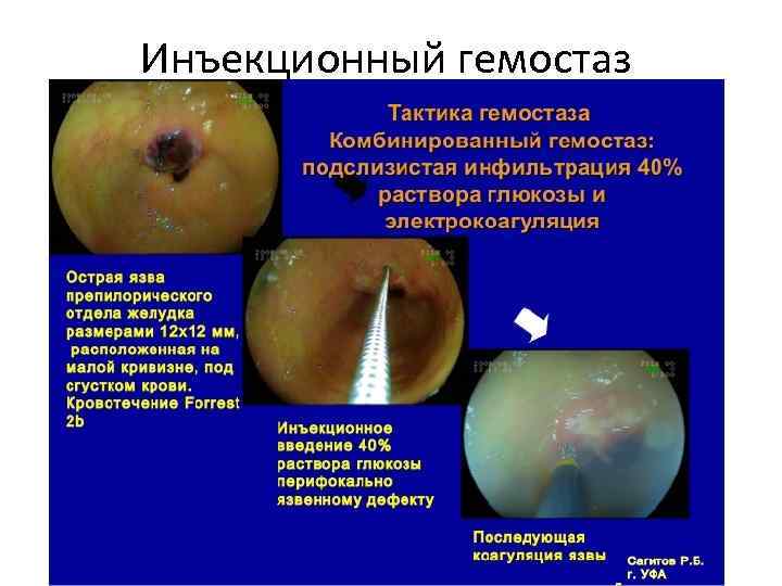 Инъекционный гемостаз 