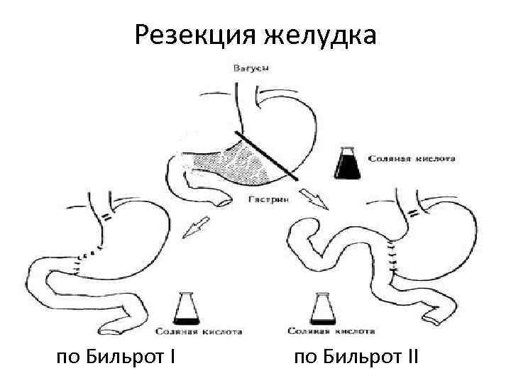 Операции по бильрот 1 и 2 схема