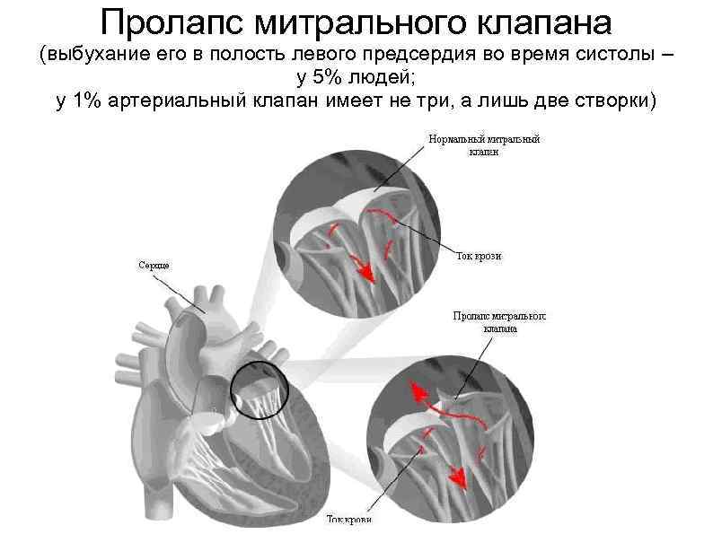 Илеоцекальный клапан губовидной формы