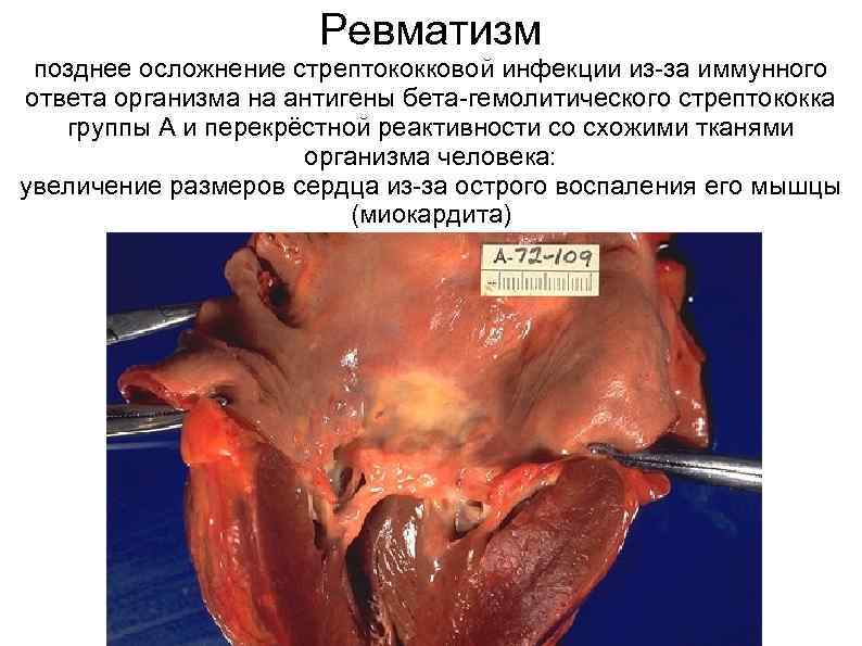 Ревматизм позднее осложнение стрептококковой инфекции из-за иммунного ответа организма на антигены бета-гемолитического стрептококка группы