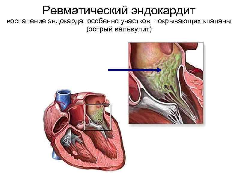 Ревматический эндокардит воспаление эндокарда, особенно участков, покрывающих клапаны (острый вальвулит) 