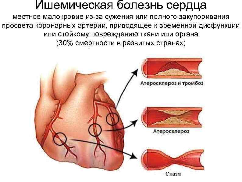 Ишемическая болезнь сердца местное малокровие из-за сужения или полного закупоривания просвета коронарных артерий, приводящее