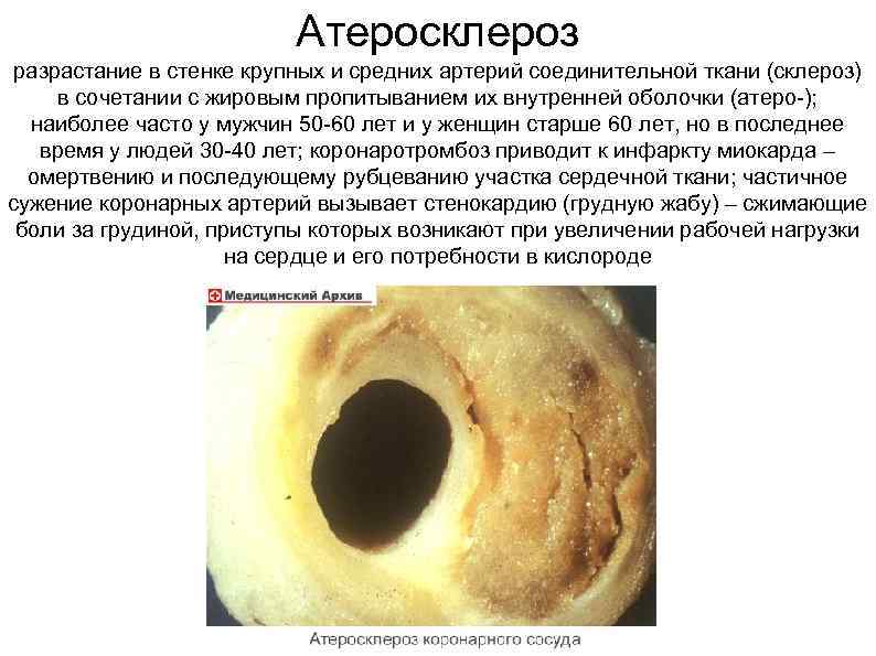 Атеросклероз разрастание в стенке крупных и средних артерий соединительной ткани (склероз) в сочетании с
