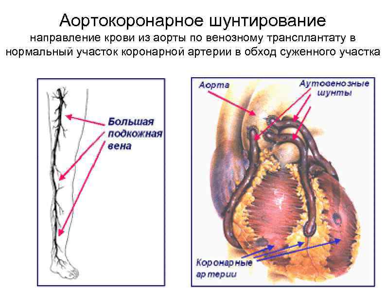 Аортокоронарное шунтирование направление крови из аорты по венозному трансплантату в нормальный участок коронарной артерии