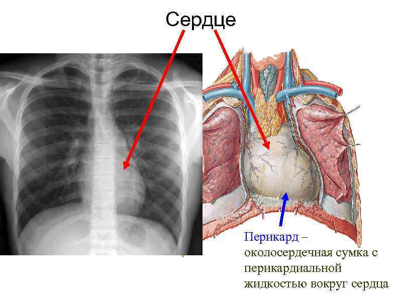 Сердце Перикард – околосердечная сумка с перикардиальной жидкостью вокруг сердца 