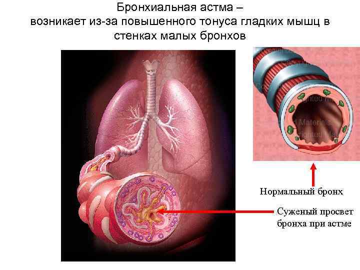 Стенки бронхов