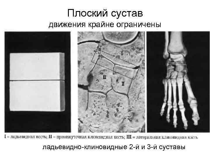 Плоский сустав движения крайне ограничены ладьевидно-клиновидные 2 -й и 3 -й суставы 