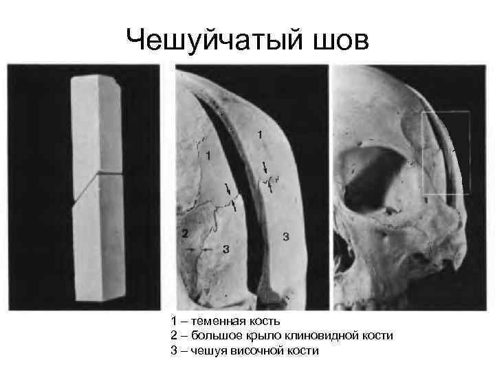 Чешуйчатый шов 1 – теменная кость 2 – большое крыло клиновидной кости 3 –