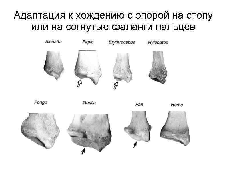 Адаптация к хождению с опорой на стопу или на согнутые фаланги пальцев 