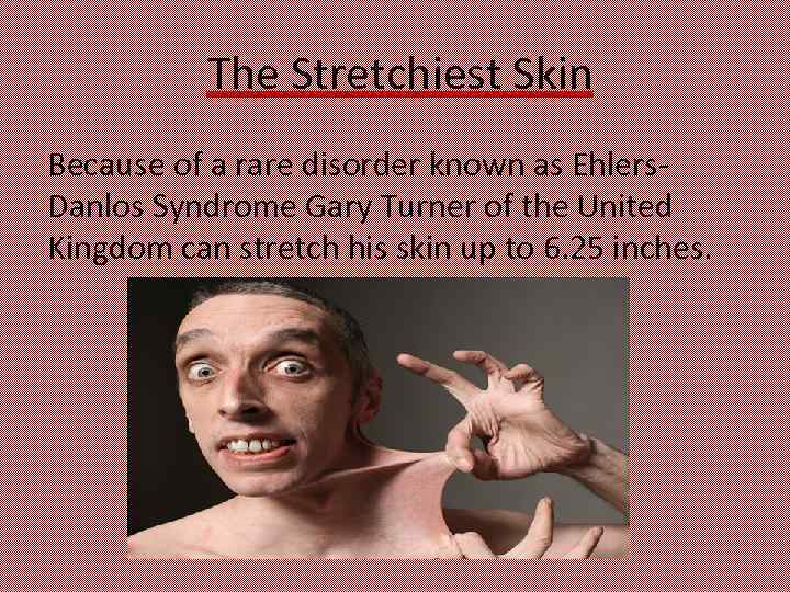  The Stretchiest Skin Because of a rare disorder known as Ehlers. Danlos Syndrome