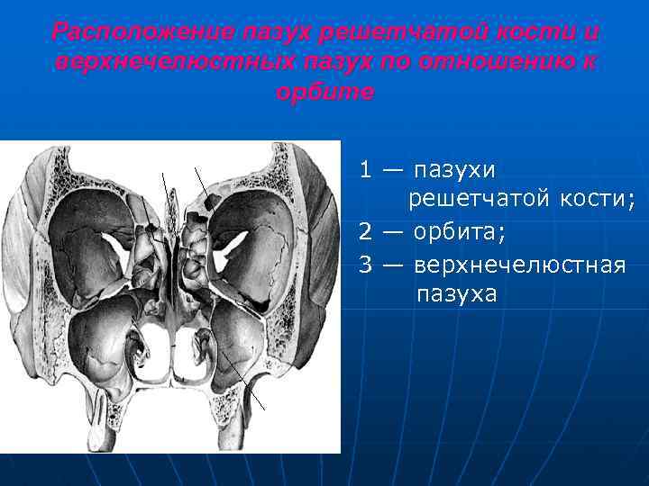 Расположение пазух решетчатой кости и верхнечелюстных пазух по отношению к орбите 1 — пазухи