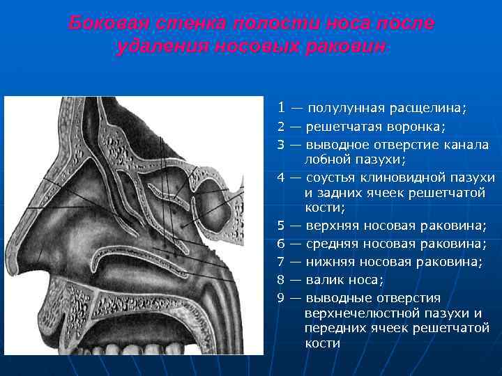 Боковая стенка полости носа после удаления носовых раковин 1 — полулунная расщелина; 2 —