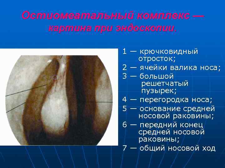 Остиомеатальный комплекс — картина при эндоскопии. 1 — крючковидный отросток; 2 — ячейки валика