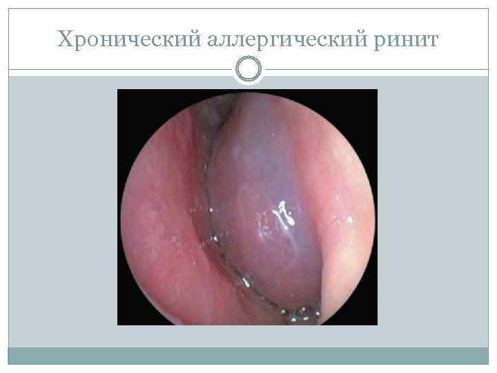 Хронический аллергический ринит 