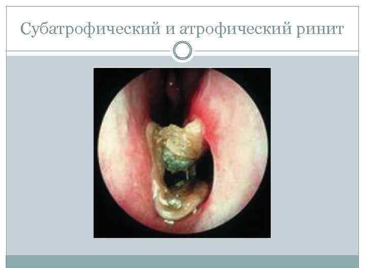 Субатрофический и атрофический ринит 