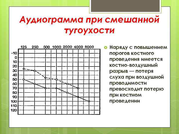Аудиограмма при смешанной тугоухости Наряду с повышением порогов костного проведения имеется костно-воздушный разрыв —