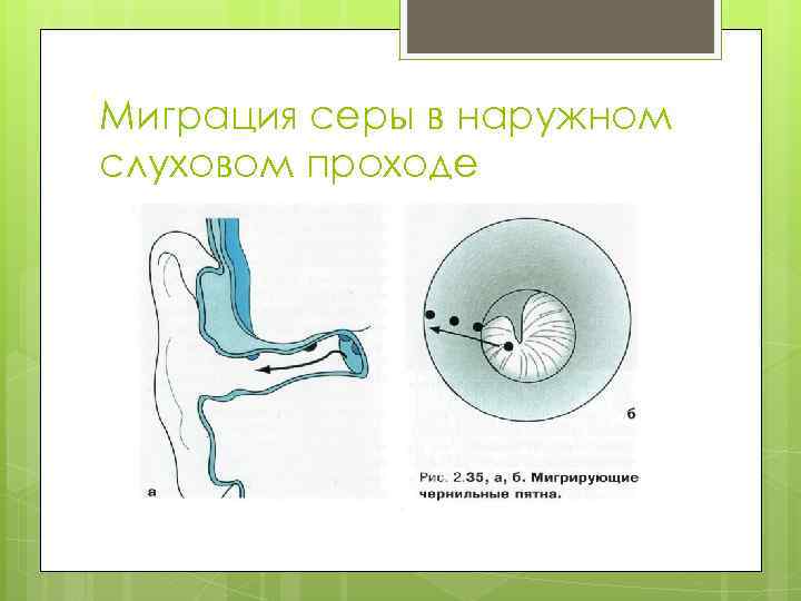 Миграция серы в наружном слуховом проходе 