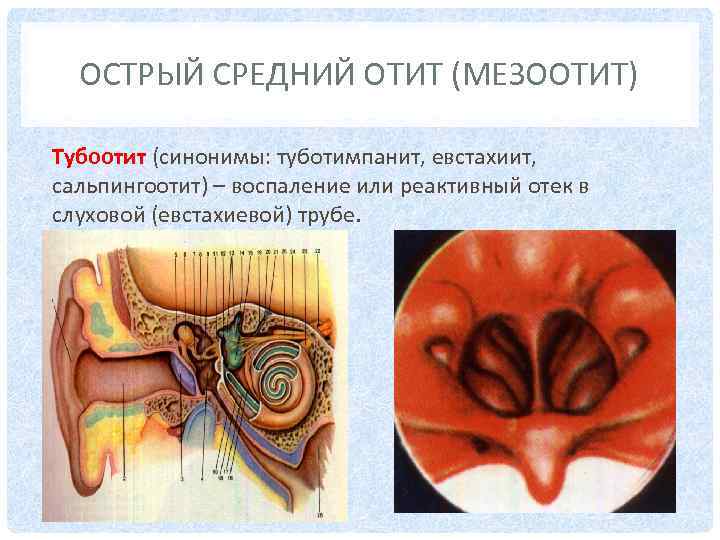 ОСТРЫЙ СРЕДНИЙ ОТИТ (МЕЗООТИТ) Тубоотит (синонимы: туботимпанит, евстахиит, сальпингоотит) – воспаление или реактивный отек