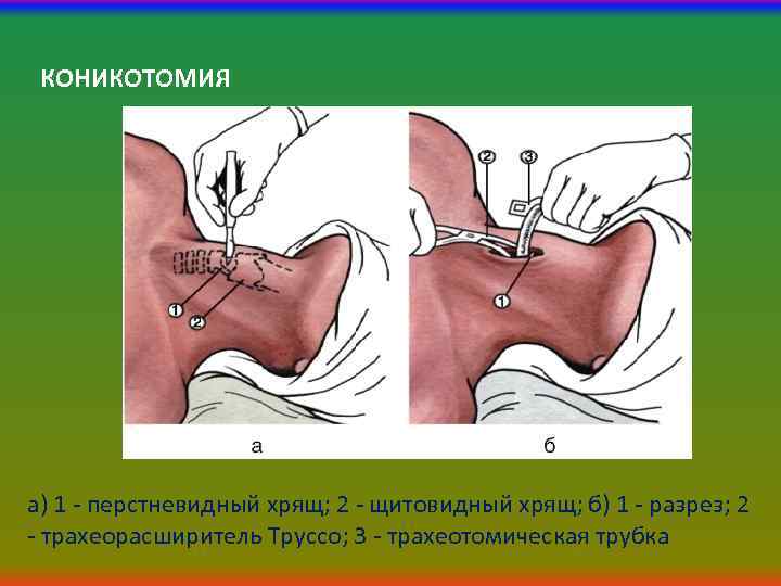 КОНИКОТОМИЯ а) 1 - перстневидный хрящ; 2 - щитовидный хрящ; б) 1 - разрез;