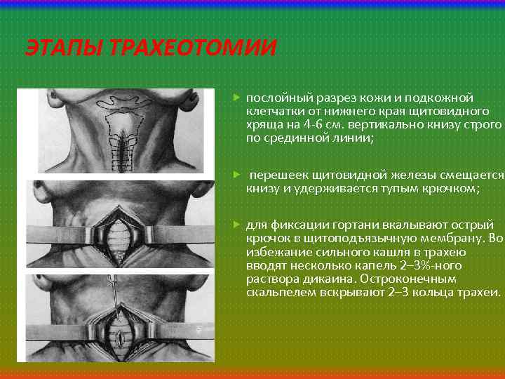 ЭТАПЫ ТРАХЕОТОМИИ послойный разрез кожи и подкожной клетчатки от нижнего края щитовидного хряща на