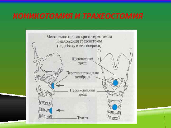 КОНИКОТОМИЯ И ТРАХЕОСТОМИЯ 