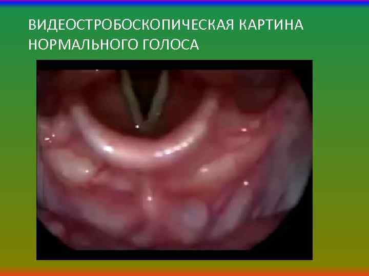 ВИДЕОСТРОБОСКОПИЧЕСКАЯ КАРТИНА НОРМАЛЬНОГО ГОЛОСА 