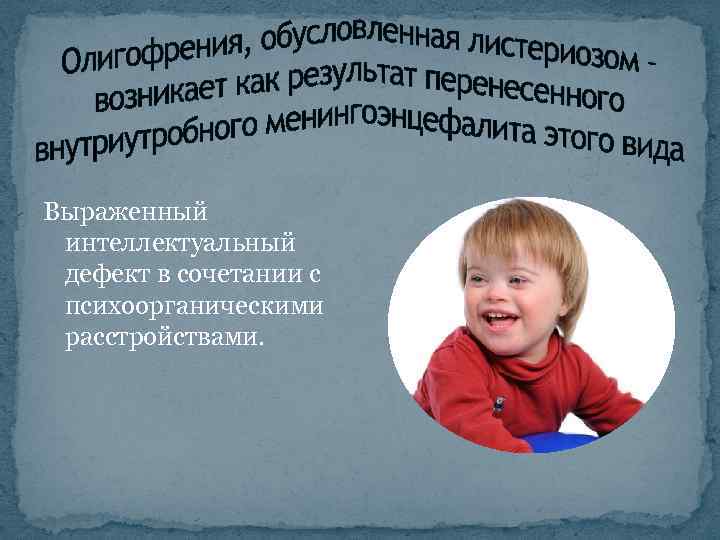 Выраженный интеллектуальный дефект в сочетании с психоорганическими расстройствами. 