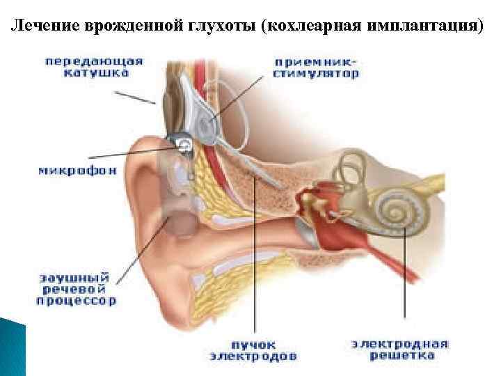 У человека врожденная глухота. Причины врожденной глухоты. Врожденная глухота схема. Глухота новорожденных.