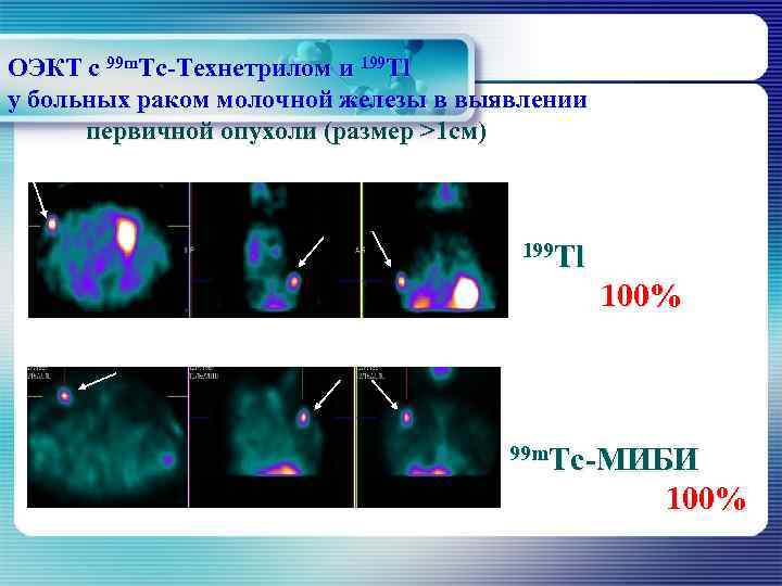 ОЭКТ с 99 m. Тс-Технетрилом и 199 Тl у больных раком молочной железы в