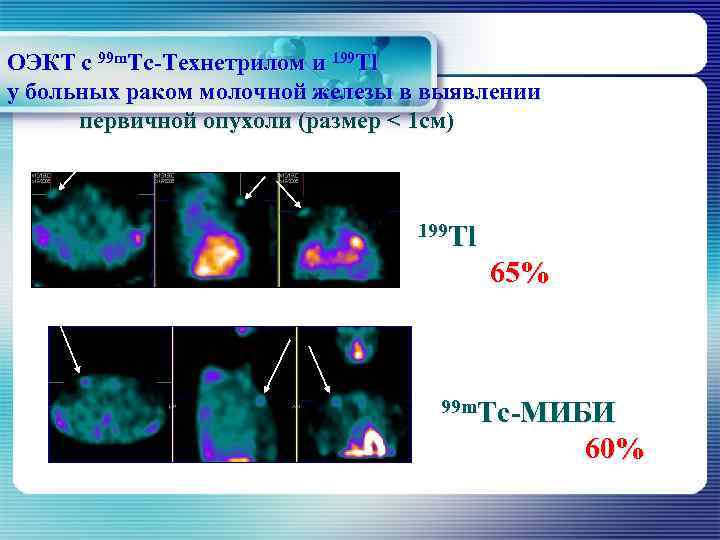 ОЭКТ с 99 m. Тс-Технетрилом и 199 Тl у больных раком молочной железы в