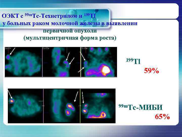ОЭКТ с 99 m. Тс-Технетрилом и 199 Тl у больных раком молочной железы в