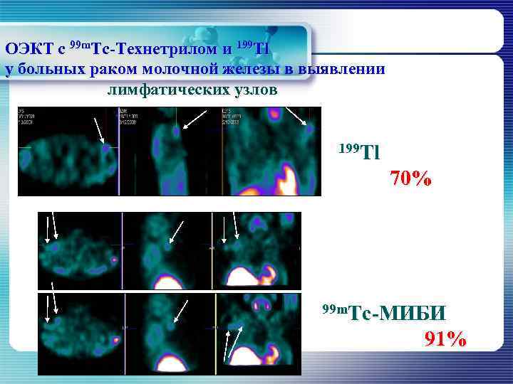 ОЭКТ с 99 m. Тс-Технетрилом и 199 Тl у больных раком молочной железы в