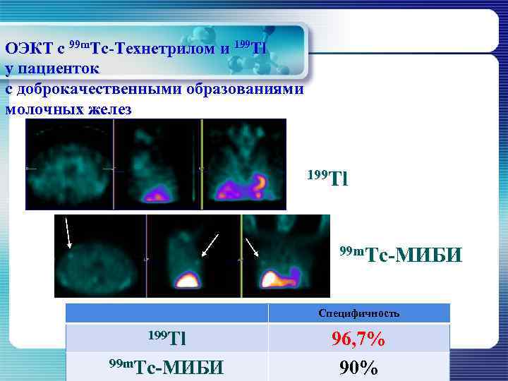 ОЭКТ с 99 m. Тс-Технетрилом и 199 Тl у пациенток с доброкачественными образованиями молочных