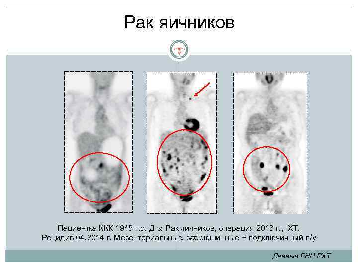 Рак яичников Пациентка ККК 1945 г. р. Д-з: Рак яичников, операция 2013 г. ,