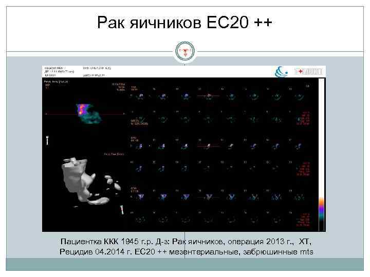 Рак яичников EC 20 ++ Пациентка ККК 1945 г. р. Д-з: Рак яичников, операция