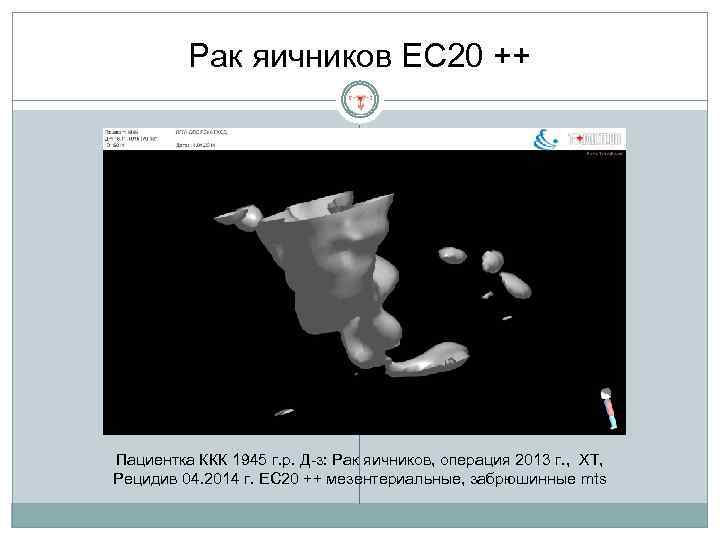 Рак яичников EC 20 ++ Пациентка ККК 1945 г. р. Д-з: Рак яичников, операция