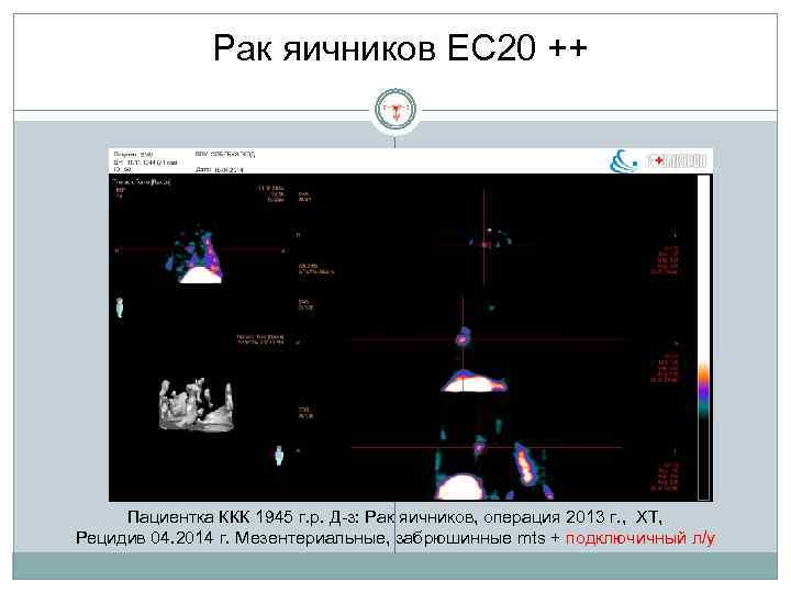 Рак яичников EC 20 ++ Пациентка ККК 1945 г. р. Д-з: Рак яичников, операция