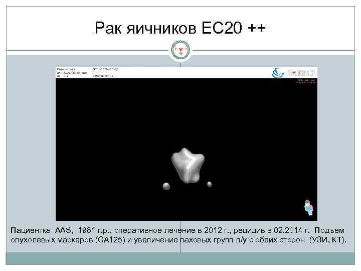 Рак яичников EC 20 ++ Пациентка AAS, 1961 г. р. , оперативное лечение в