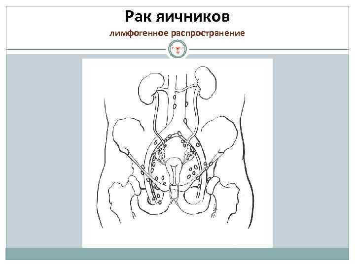 Рак яичников лимфогенное распространение 