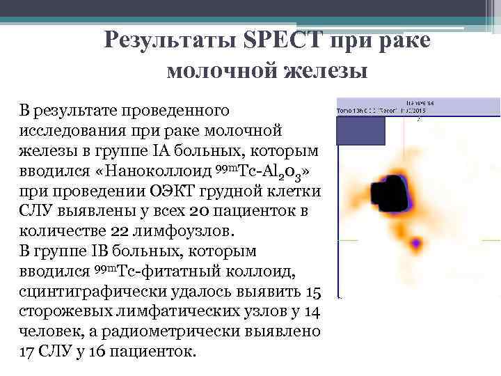 Результаты SPECT при раке молочной железы В результате проведенного исследования при раке молочной железы