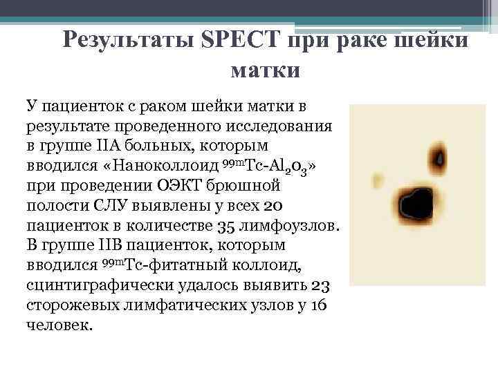 Результаты SPECT при раке шейки матки У пациенток с раком шейки матки в результате