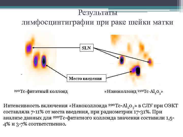 Результаты лимфосцинтиграфии при раке шейки матки SLN Место введения 99 m. Tc-фитатный коллоид «Наноколлоид